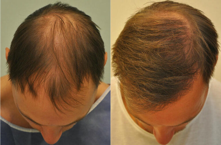 hajbeultetes elotte utana 2 c 768x505