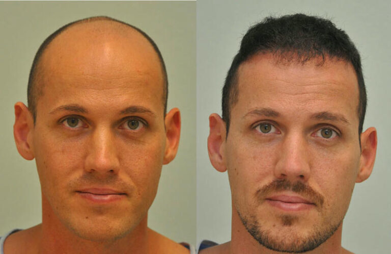 hajbeultetes elotte utana 3 c 768x498