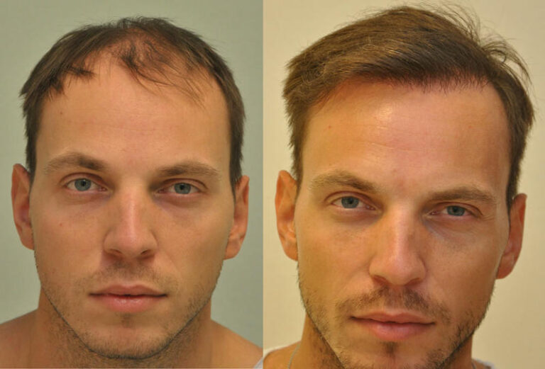 hajbeultetes elotte utana c 768x521