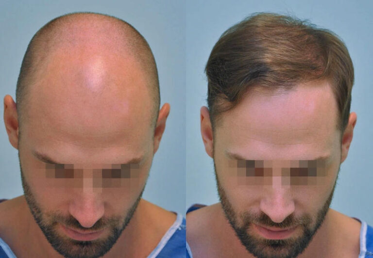 sikos hajbeultetes elotte utana 03 c 768x532